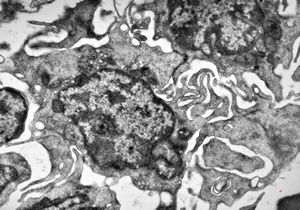 M,73y. | bone marrow - hairy cell leukemia M,73y. | bone marrow - hairy cell leukemia
